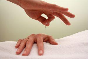 Dastellung der Akupunktur am Handrücken