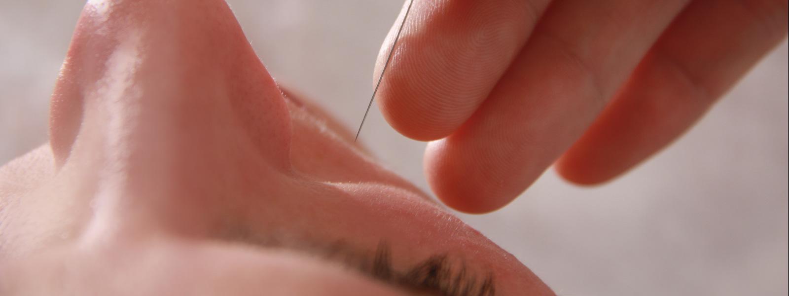 Setzen der Akupunktur-Nadel