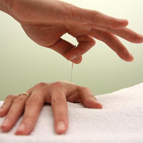 Hand-Akupunktur